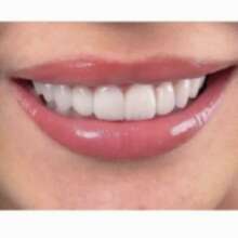 Керамические виниры в Екатеринбурге под ключ